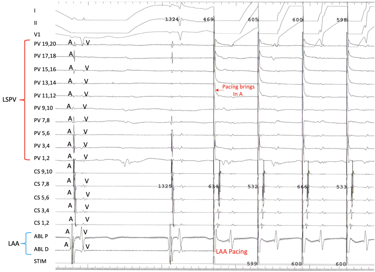 Electrogram Interpretation - 4 - EP Essentials