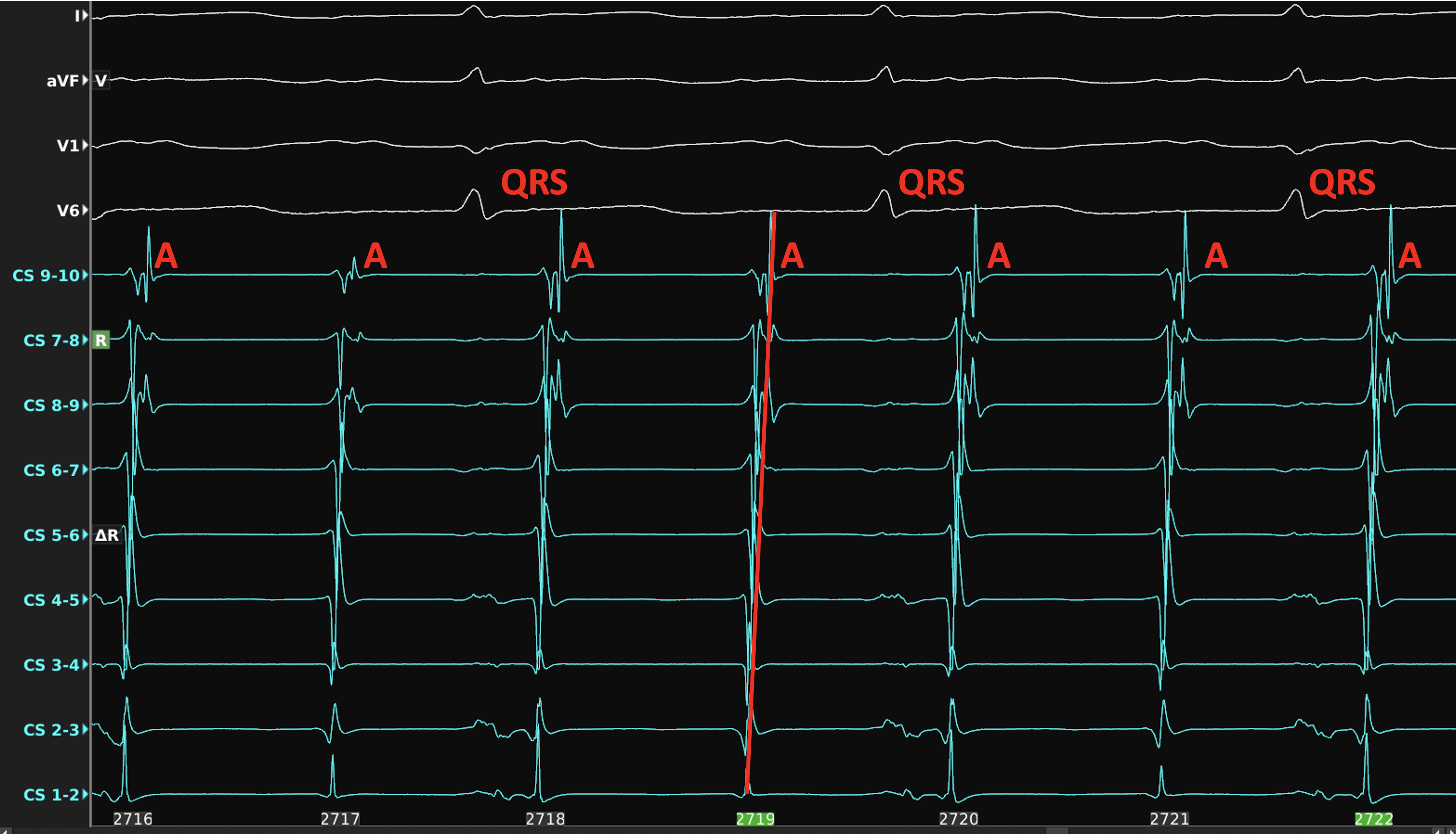 episodic atrial flutter icd 10