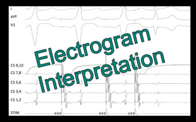 Electrogram Interpretation – 13