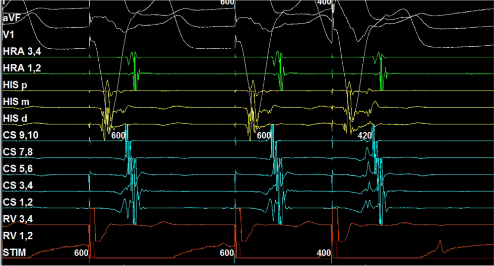Electrogram Interpretation - 22 - EP Essentials