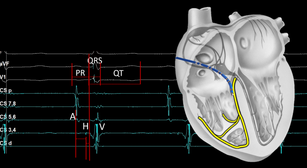 EP 101 Signals & Catheter Positioning EP Essentials